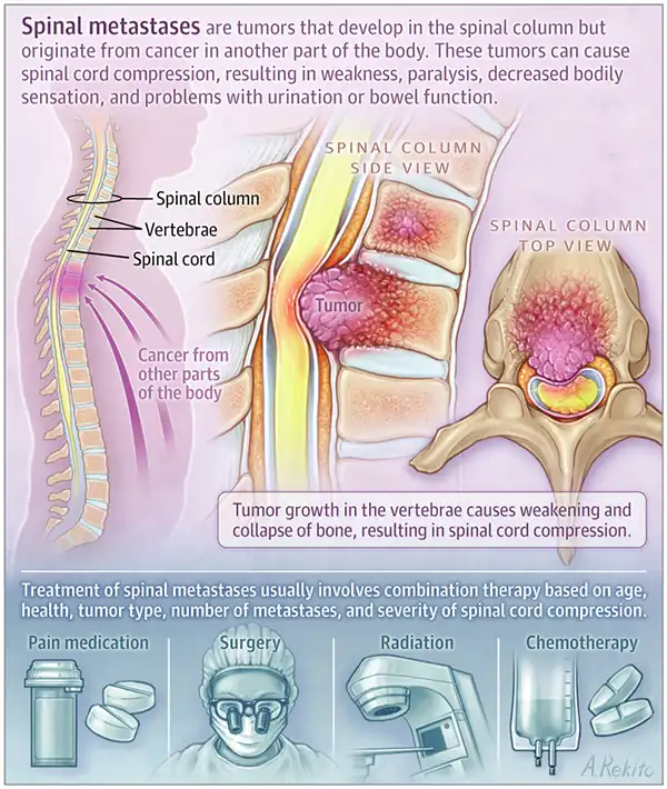 Spinal metastases are formed when a cancerous tumor spreads to the vertebral column with blood flow from the foci of their primary occurrence.